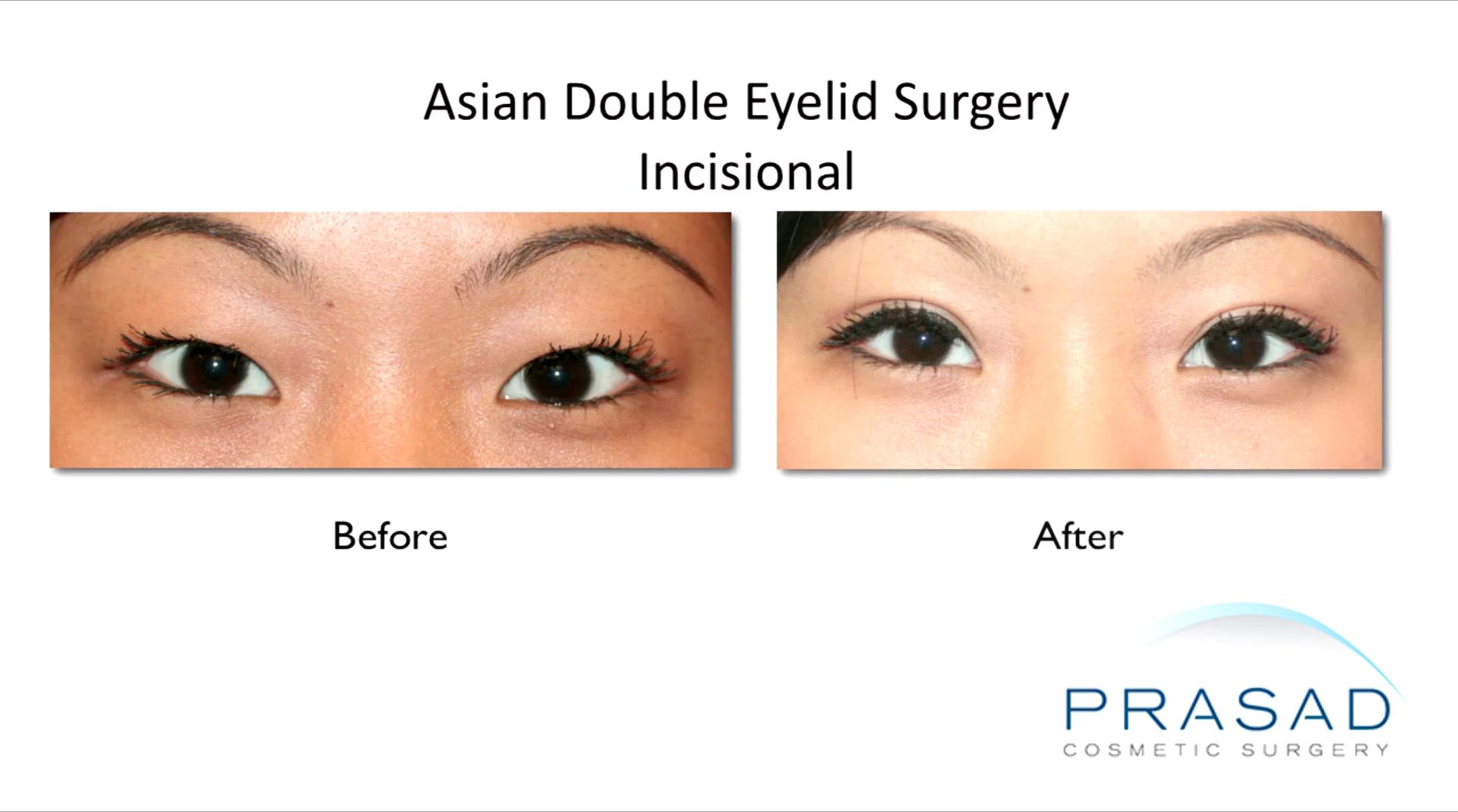 double eyelid surgery recovery process pictures