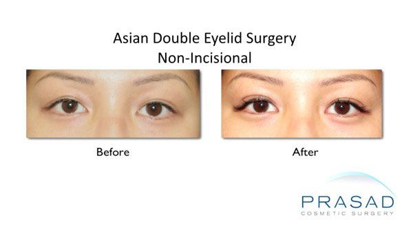 Asian Eyelid Surgery | Double Eyelid Surgery | Specialist NY