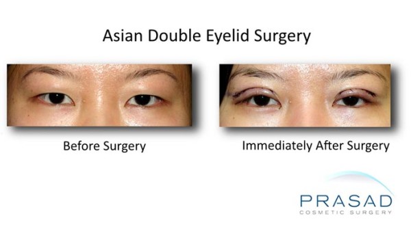 double eyelid surgery recovery process pictures