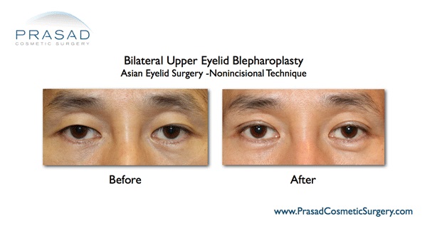 Asian Eyelid Surgery | Double Eyelid Surgery | Specialist NY