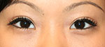after double eyelid surgery