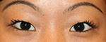 Asian Eyelid Surgery Before