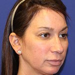 Before Vampire facelift by Dr Amiya Prasad