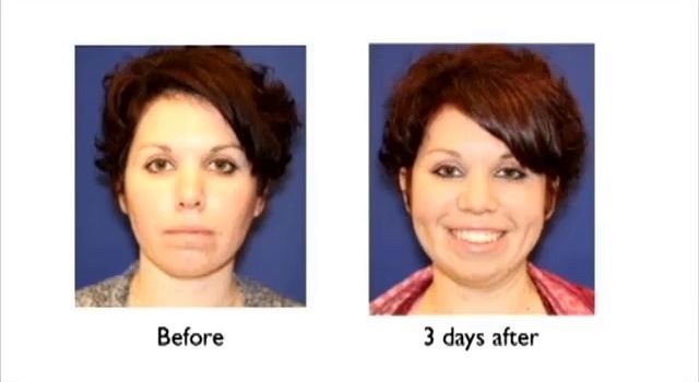 Dimple Surgery Dimple Creation Learn More New York