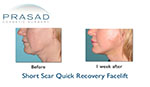 before and after s-lift facelift