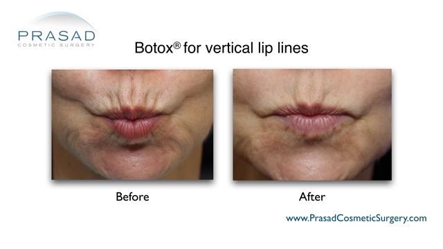 Botox® for reducing vertical lip lines