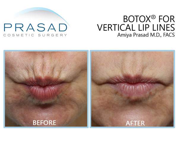 Vertical lip lines before and after Botox