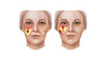 cheek descent and lift