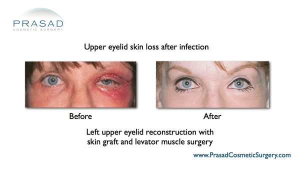 how is eyelid surgery performed