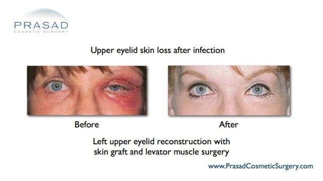 Complication after eyelid surgery 