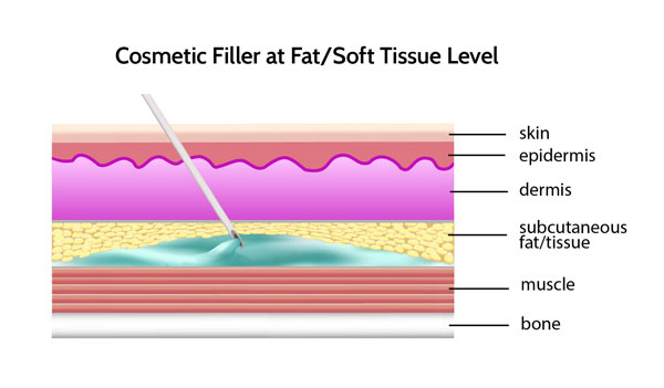 cosmetic filler placed at fat or soft tissue level