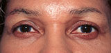patient photo after dark circle treatment