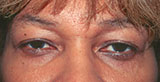 before dark circle treatment photo