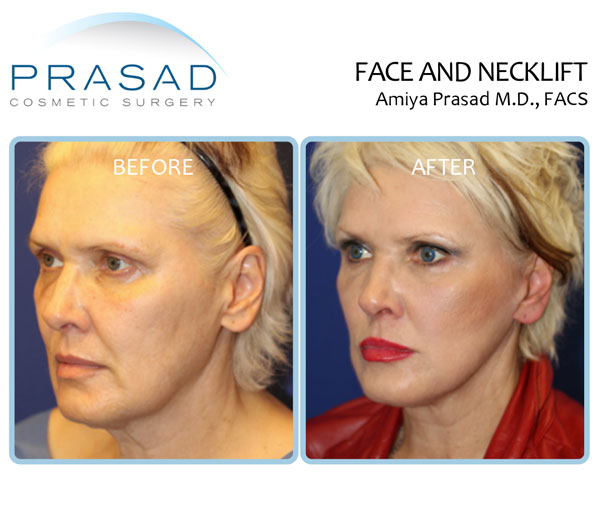 Deep plane facelift and neck lift before and after