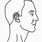 Diagram of short scar facelift incision