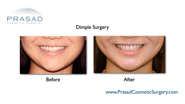 Dimple surgery | Dimple Creation | Learn More - New York