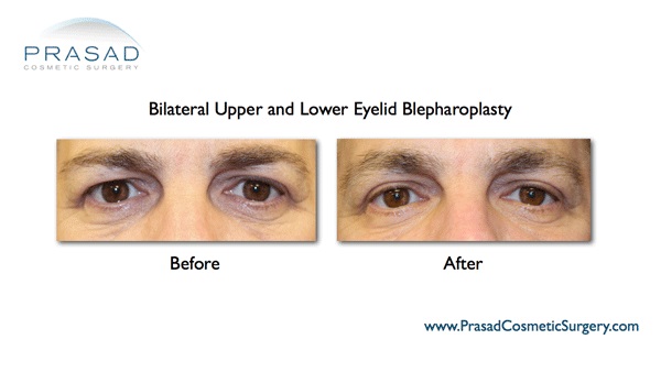 Upper Eyelid Surgery and Recovery | Eyelid Surgery in New York