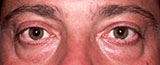 before eyebags surgery