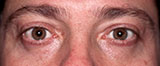 after eyebags surgery
