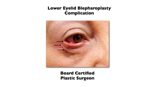 lower eyelid blepharoplasty complication done somewhere else