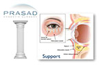 eyelid support