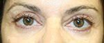 patient after eyelid surgery
