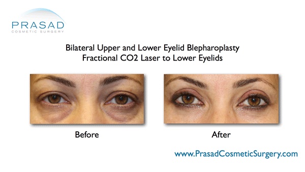 Upper Eyelid Surgery and Recovery | Eyelid Surgery in New York