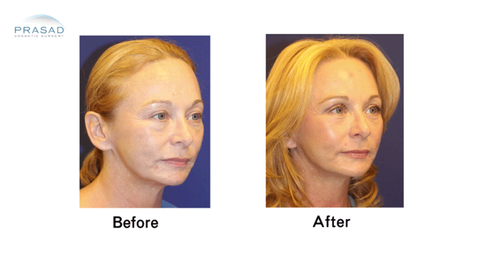 Facelift Patient Before and After
