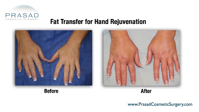Fat transfer to hands before and after