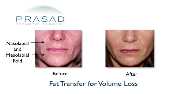 fat transfer for volume loss