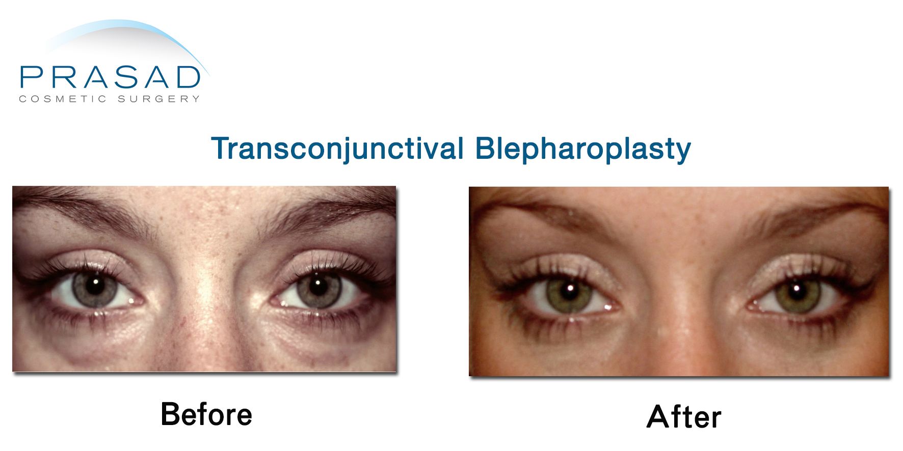 transconjunctival blepharoplasty