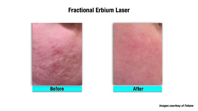 Non-ablative laser treatment of acne scars