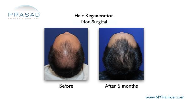 6 months after hair regeneration treatment