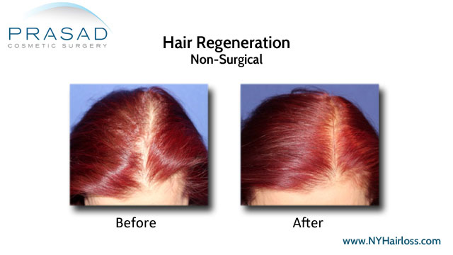 Hair Regeneration treatment’s effect on female pattern hair loss 