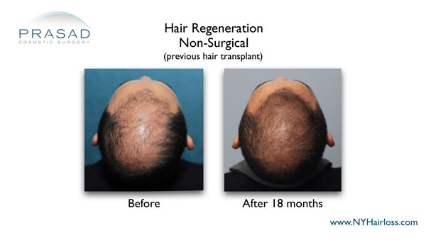 Hair Regeneration treatment can also help people who’ve had hair transplants 