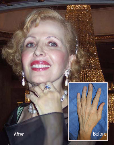 Hand Rejuvenation