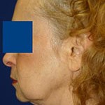 jowls before treatment