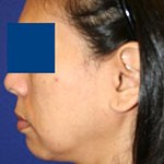 patient's jowls before treatment