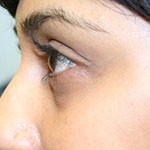after juvederm treatment