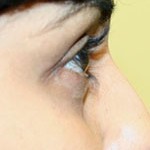 after juvederm treatment
