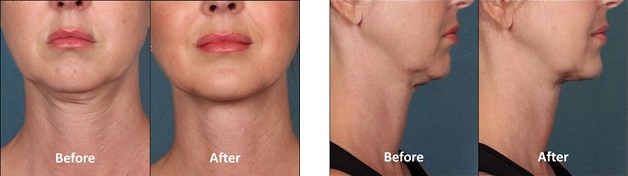 Kybella trial results