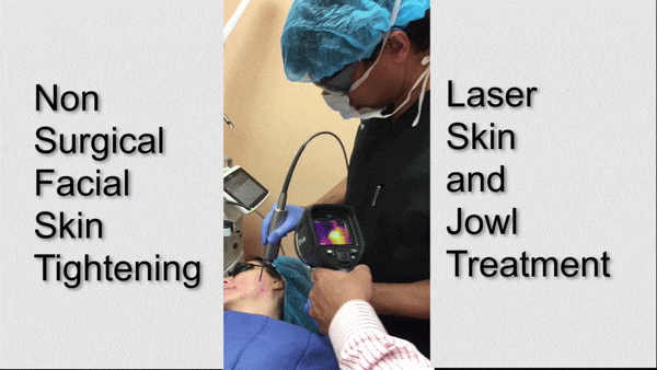 Non-surgical laser facial skin tightening