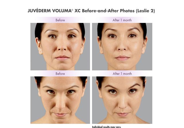 female model before and after Juvederm voluma 1 month treatment