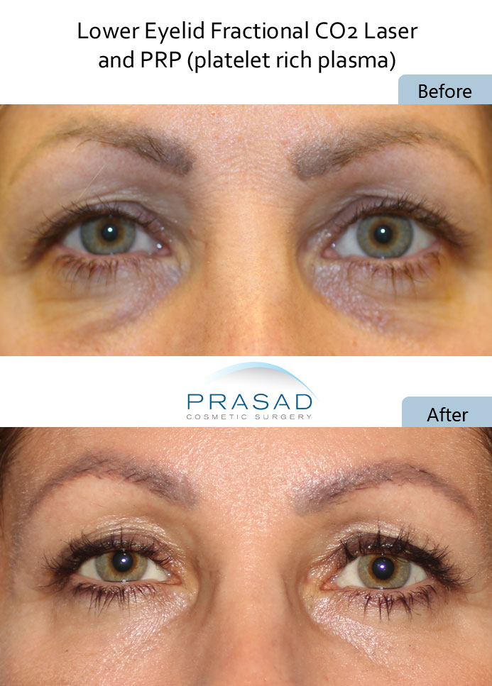 dark circles under eyes treatment with PRP