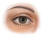 Lower eyelid outside incision