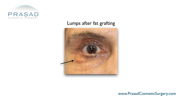 Under eye fat grafting complications