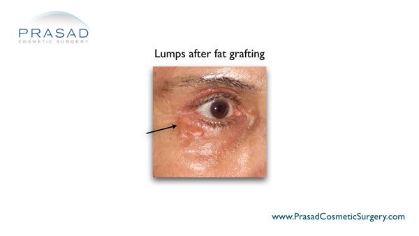 lumps after fat grafting illustration