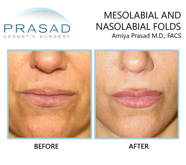 nasolabial folds and mesolabial folds treated with cosmetic filler