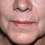 nasolabial fold before treatment