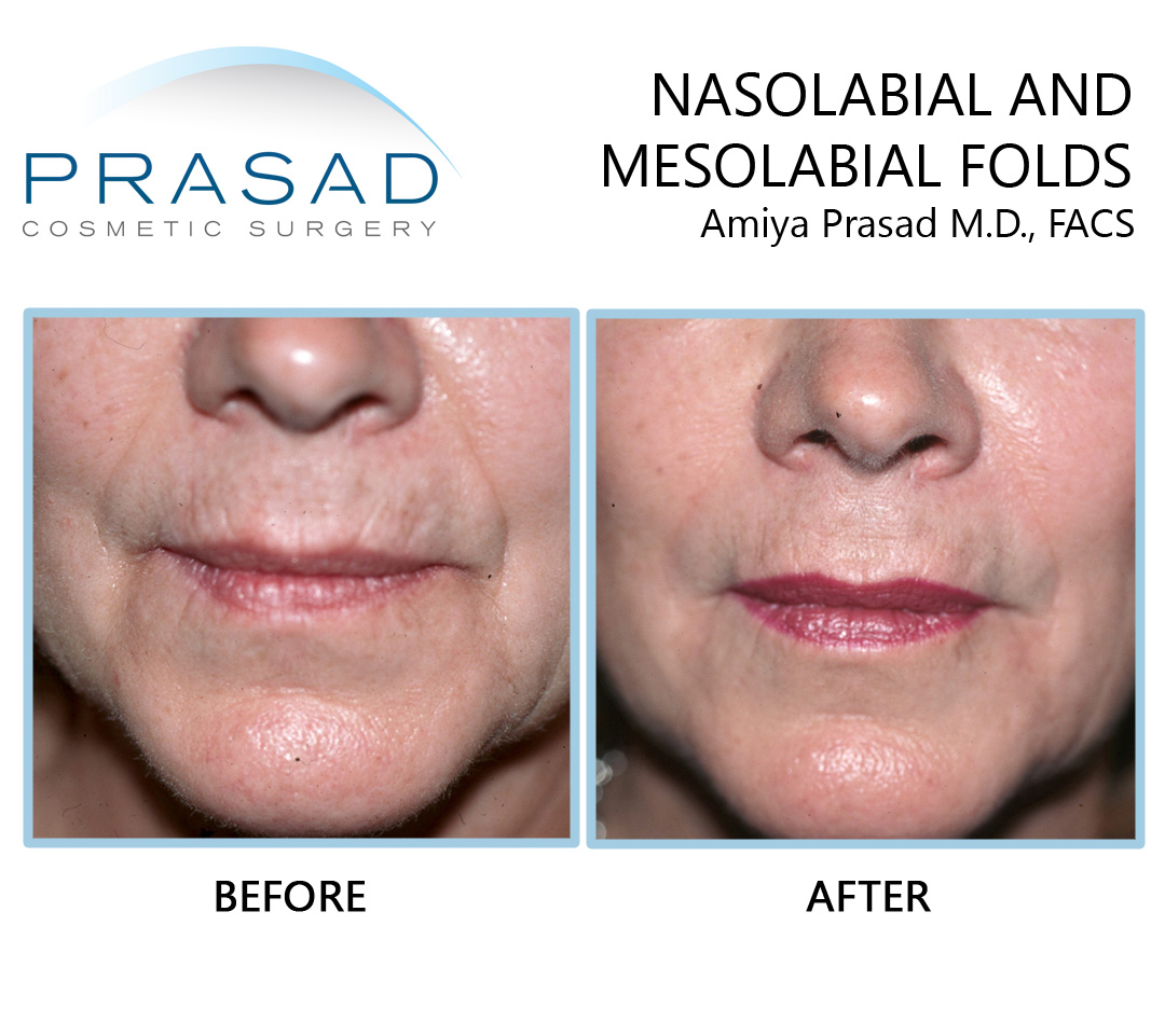 Nasolabial and mesolabial folds before and after filler treatment